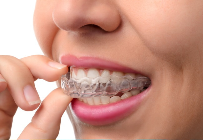 Invisalign